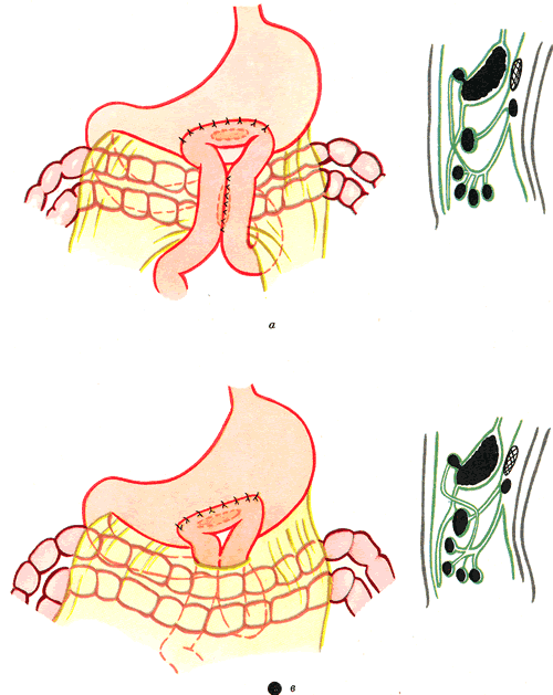 Операция желудка кишечника. Передний желудочно кишечный анастомоз. Задняя гастроэнтеростомия по Гаккеру петерсону. Гастроэнтеростомия топографическая анатомия. Задний желудочно кишечный анастомоз.