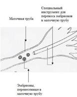 Описание: Перенос гамет и зигот в маточные трубы
