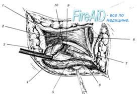 �������� �������� ������ �� McVay ( Cooper ligament repair ).
