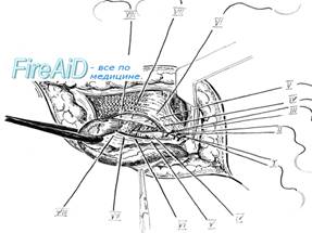 �������� �������� ������ �� McVay ( Cooper ligament repair ).