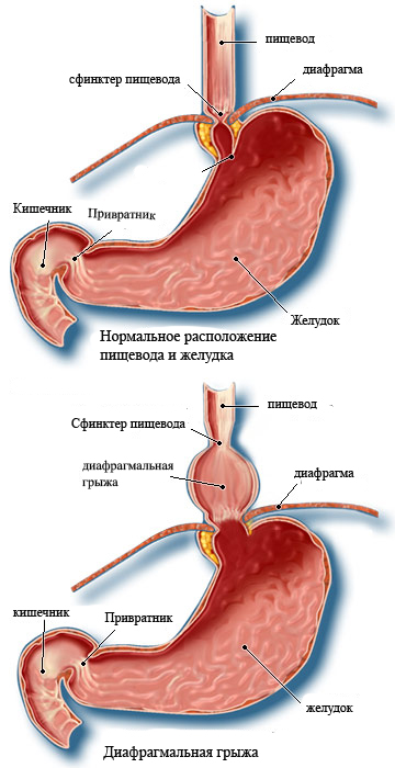 диафрагмальная грыжа
