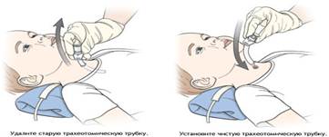 замена трахеотомической трубки